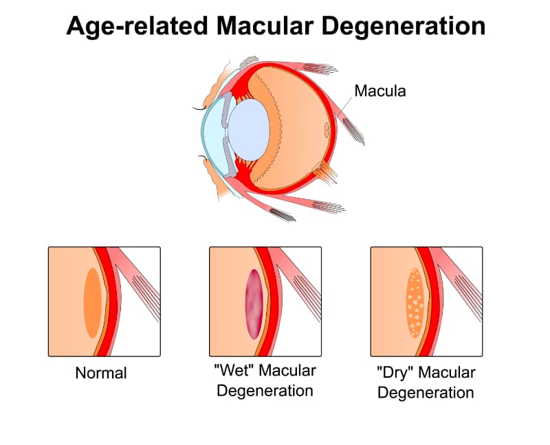 Age related Macular Degeneration Chart