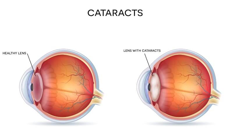 Cataract Chart