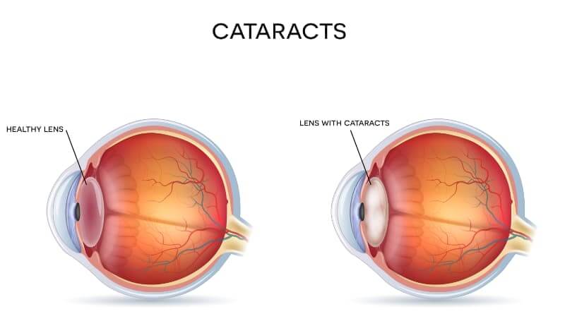 Macula: Anatomy, Function & Common Conditions