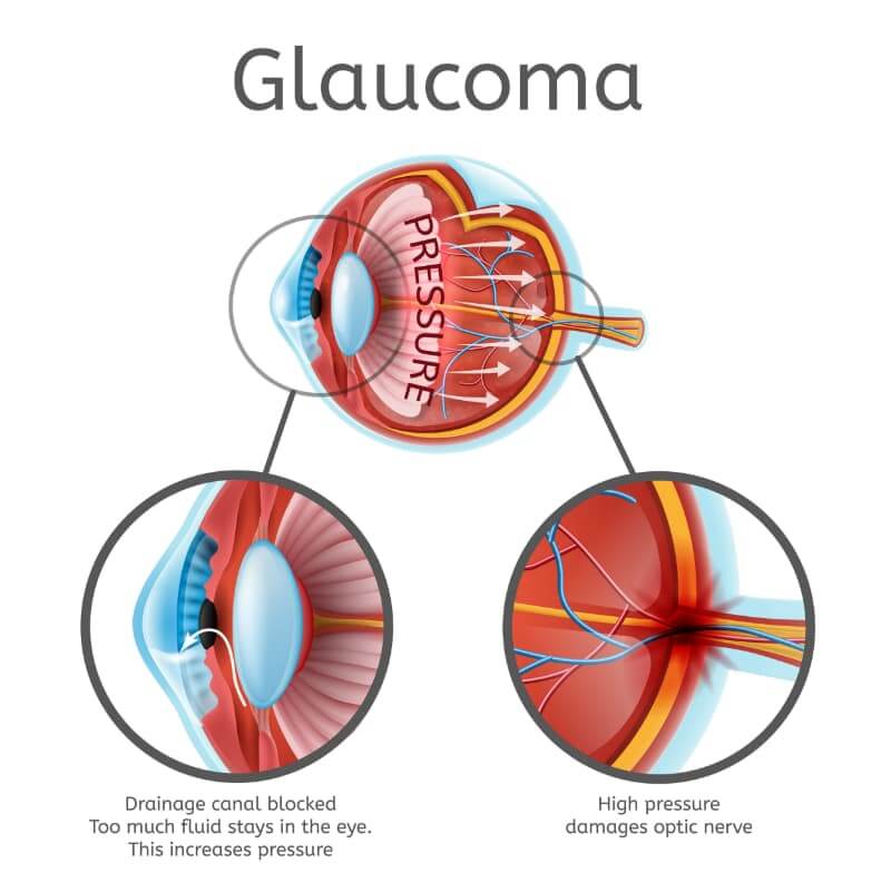 Glaucoma Chart