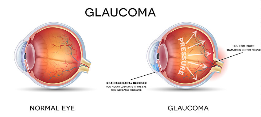 Normal Eye vs Eye with Glaucoma Illustration